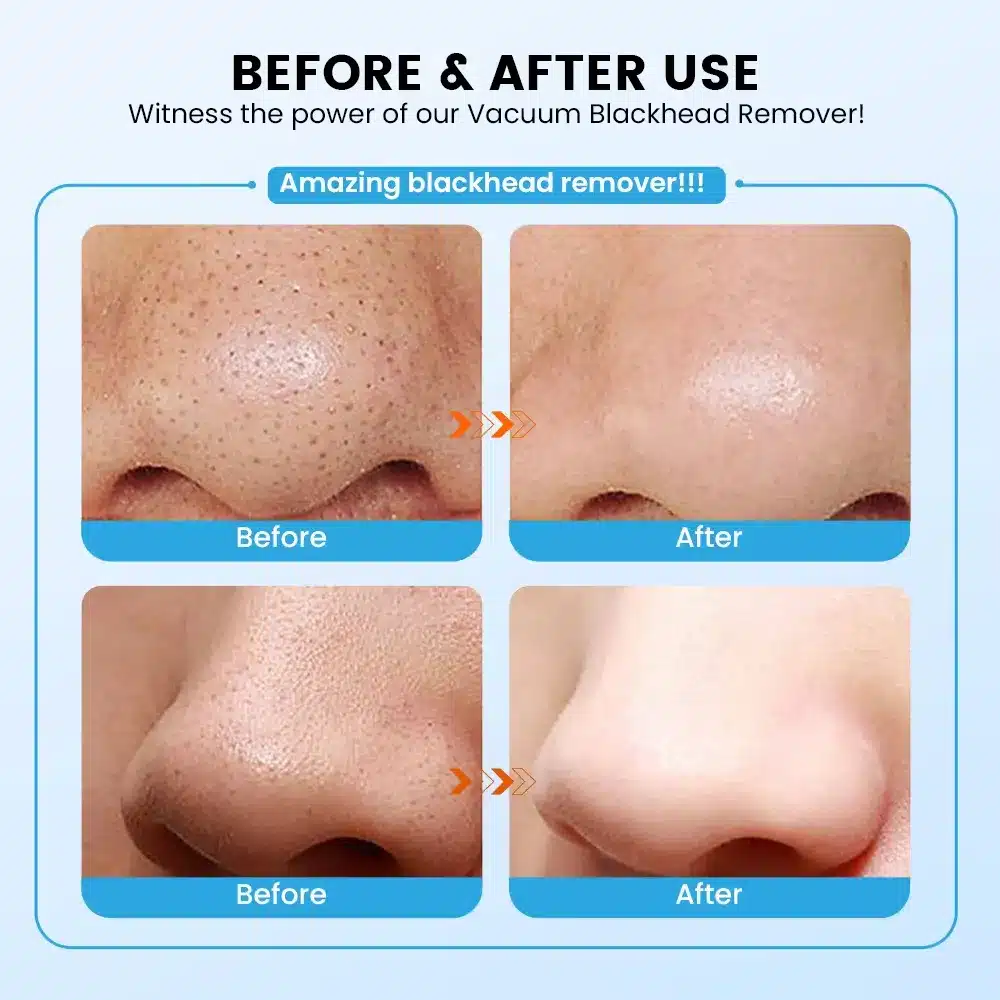 Blackhead Remover Machine – Electric Pore Cleaner Vacuum